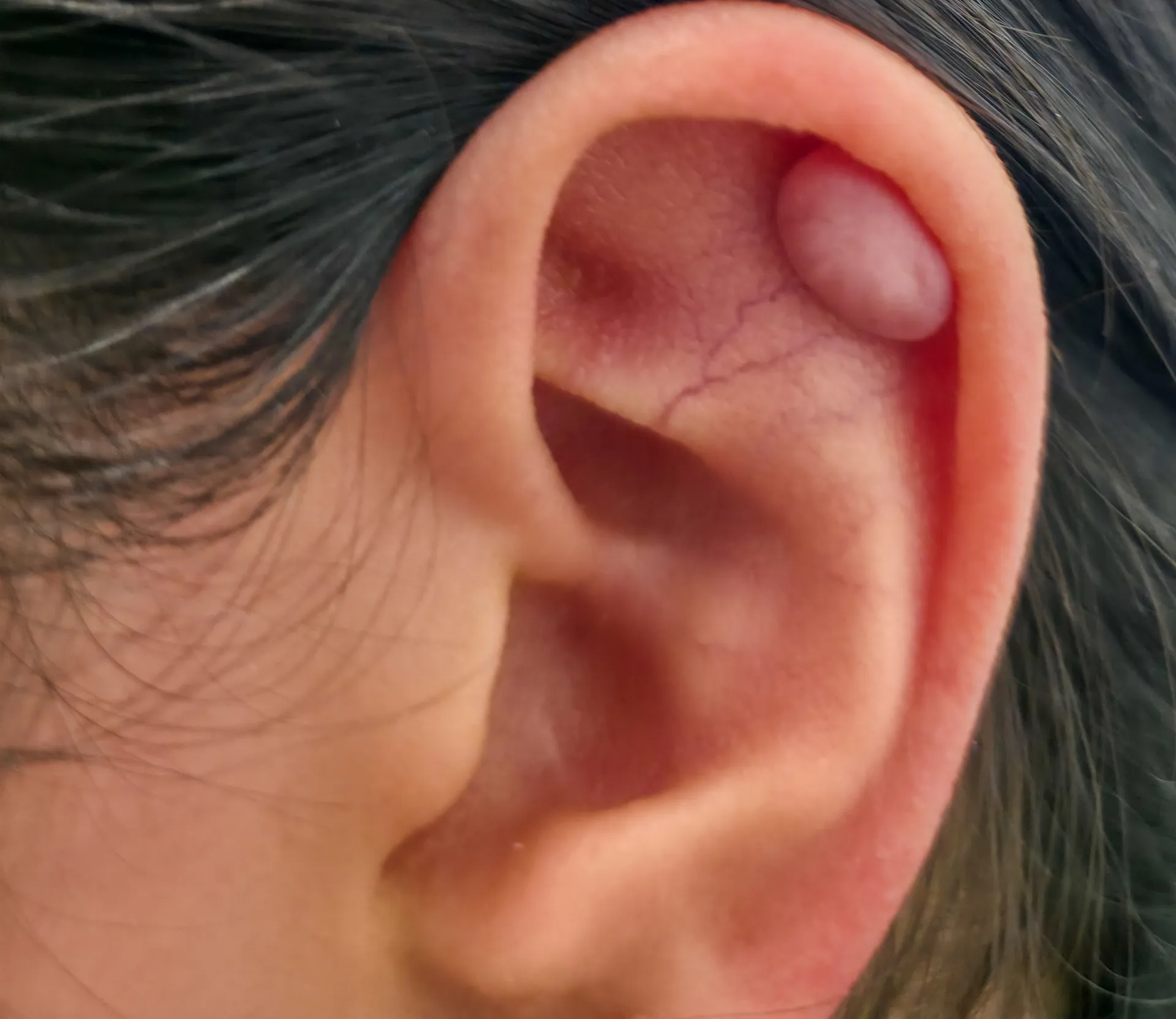 Keloid Removal Bellevue
